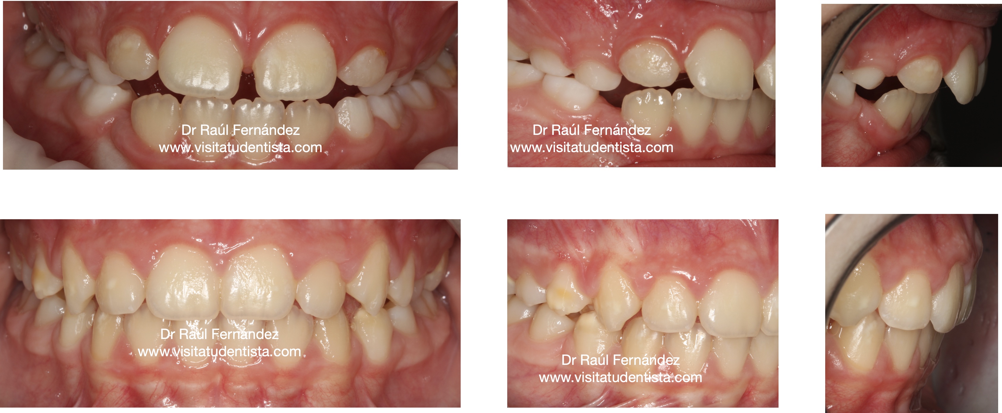 Dentosofía y seguimiento durante 5 años
